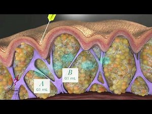Marking and Injection for QWO for the Best Cellulite Treatment