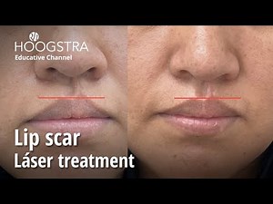 Lip scar - Láser treatment - 22321