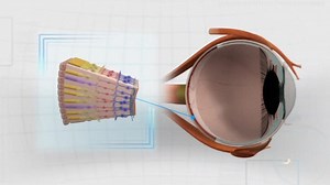 Woman undergoes bionic eye surgery in Honolulu to restore vision