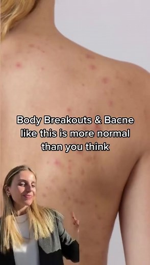 We have the perfect body cleanser for acne-prone skin that combines AHA, BHA pre- and post-biotics to say bye to body acne👋😏 #nichebeautylab #foryou #fyp #skincare #Skincare #acne #acnetreatment #bodyacne #bacne #bacnetreatment #bodyacnetreatment