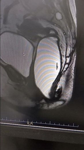 Mri Defecography