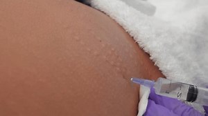 Stretch Mark Removal Procedure On Skin Stock Footage Video (100% Royalty-free) 3609398163 | Shutterstock