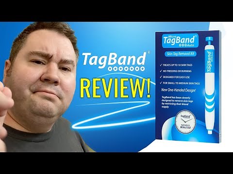 HOW TO REMOVE SKIN TAGS | Does TagBand Work? TagBand Review!