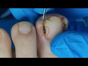 【Daily Pedicure Tutorial】Removing Deeply Embedded Ingrown Toenails on Both Sides of The Big Toe