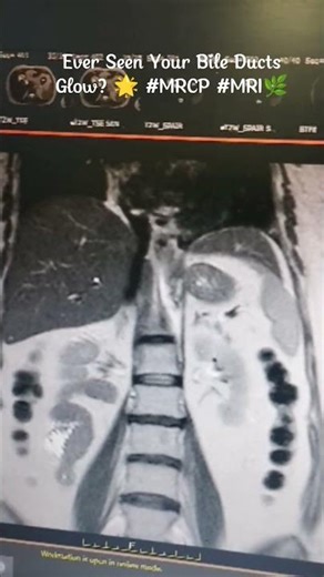 🧲Magnetic Resonance Cholangiopancreatography#MRCP#mri#radiology#radiographer#anatomy#radtech