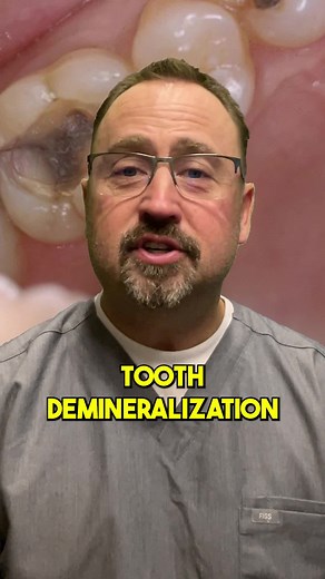 Demineralization? Remineralization? Here's why you need to know about it! #dentist #dentalcare #teeth #whiterteeth #dentistvideos #pediatricdentist