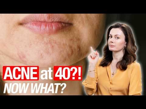 How to Fix Adult Acne Without Drying Out Your Skin (30s, 40s, Beyond)