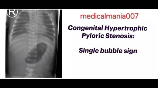 BALAJI medical education on Instagram: "Radiological indicators of neonatal intestinal obstruction - ●single bubble (stomach) suggests pyloric stenosis; ●double bubble (stomach + duodenum) indicates duodenal atresia; ●triple bubble (stomach + duodenum + proximal jejunum) often signals proximal jejunal atresia, all representing air trapped in dilated bowel loops before the obstruction. #radiology #xray #neonate #MedicalStudent #NursingStudents"