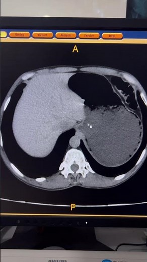 Why Oral Contrast Given in CT Scan #shorts