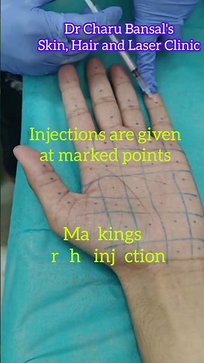 Botox injections Hands/palms for Hyperhidrosis or sweaty palms, Dr Charu Bansal, Dermatologist