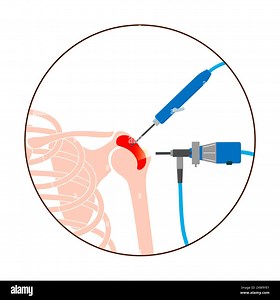 Illustration of a shoulder arthroscopy procedure. This is a procedure for diagnosing and treating joint problems. A surgeon inserts a narrow tube attached to a fibre-optic video camera through a small incision Stock Photo - Alamy
