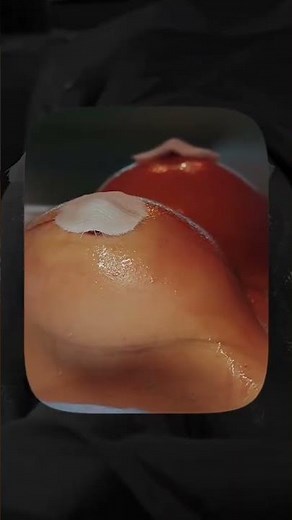 BEFORE AND AFTER A VERY SAGGY BREAST | Dr. Ícaro Samuel #mastopexy #silicone