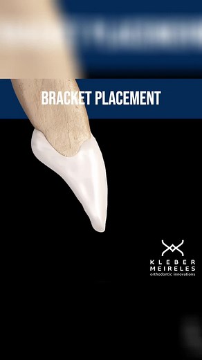 Understanding Bracket Height Changes in Orthodontics