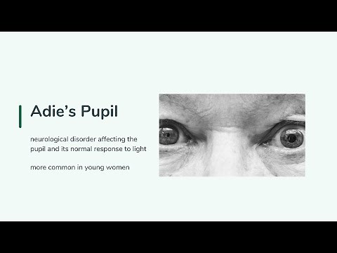 Adie's pupil - Causes, Symptoms, Diagnosis, Management.