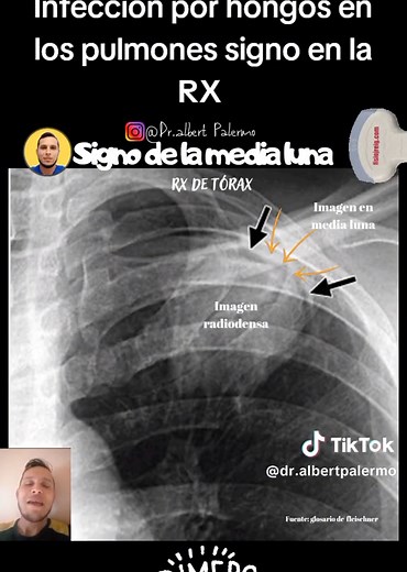 Micetoma Pulmonar: Imágenes y Signos en RX