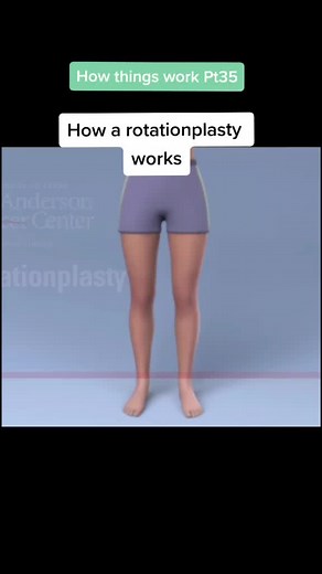 Exploring How a Rotationplasty Works