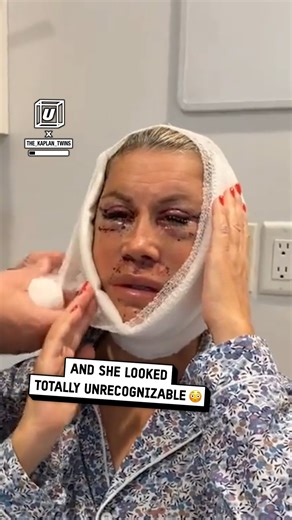 She looked unrecognisable 😳 #surgery #cosmetic #mum | UNILAD