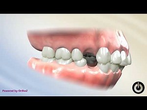 4 First Premolar Extraction for Bimaxillary Protrusion
