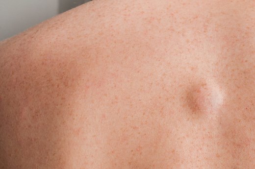 Lipome : photo, c'est quoi cette boule de graisse sous la peau ?