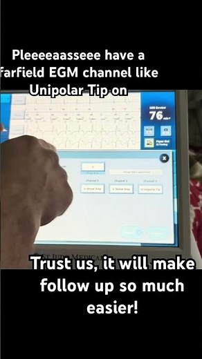 Programming Farfield EGM channels - Abbott devices #pacemaker #cardiology #cardiacelectrophysiology