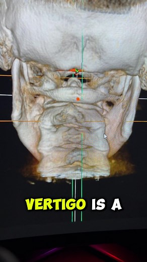Has anyone ever explained vertigo to you this way? 🤔 Let us know below 👇 Looking for a doc near you? Uccnearme.com 👍 #uccnearme #vertigo