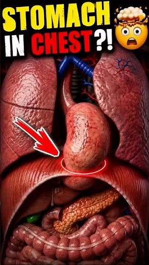 How Does a Hiatal Hernia Happen? 😱 | #hiatalhernia #acidreflux #animation #stomach #3danimation