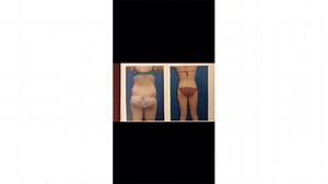 See These Dramatic Liposuction Before & Afters