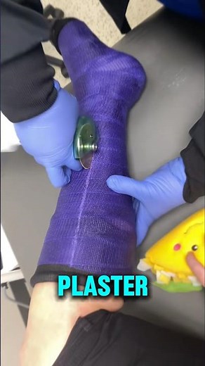 Why Do Casts Smell So Bad When Removed?