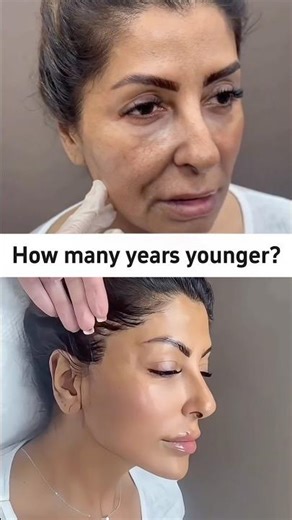 #deep9dfacelift #9dfacelift #9dfaciallifting #SMASlift #facelift #necklift #headlift #babyface