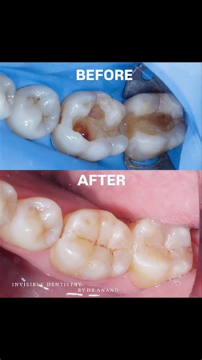 Garrison Dental Solutions on Instagram: "Case study using Garrison’s Quad Matrix System by @invisibledentistry_bydranand What looked like a simple Class 1 on tooth 37 turned out to hide adjacent Class 2 defects, always look closer than what meets the eye! 🦷✨ Learn more about Quad Matrix System by clicking the link in bio 🔗"