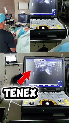 Large, calcific Achilles Tendinopathy treated with TENX