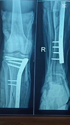 How a Comminuted Tibia Fracture Is Fixed? #legs #kneepain #jointpain #orthopedics #surgery #doctor