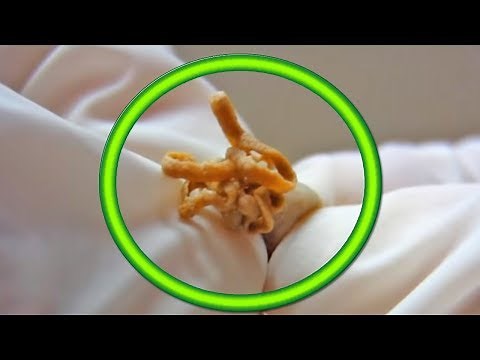 Dog Cysts! Biggest Cyst on Pets (Educational)