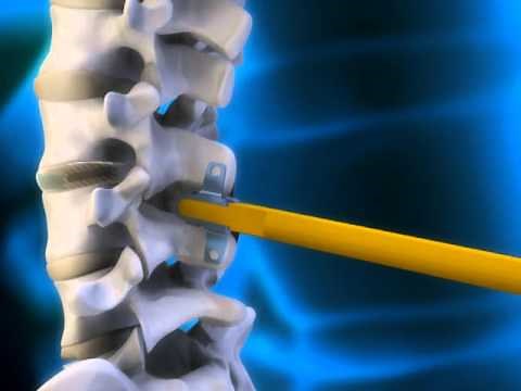 Initial Insertion of coflex-F® | Paradigm Spine | Spine Doctors