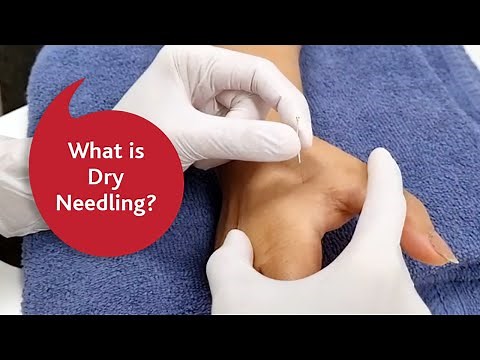 What is dry needling?