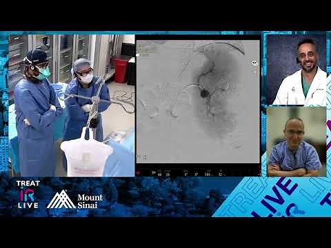 Transfemoral Coil Embolization of a Splenic Artery Aneurysm