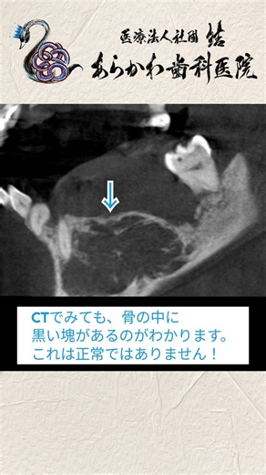 見逃されてた病気！歯医者で撮ったレントゲンは虫歯や歯周病だけをみるためではない！ #あらかわ歯科医院