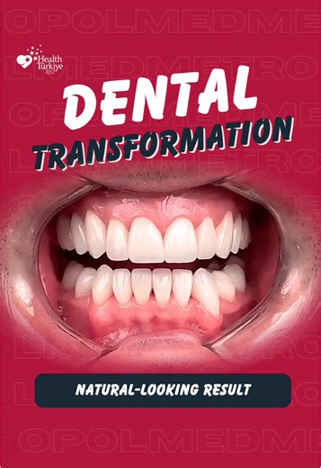 E-max crowns are advanced all-ceramic restorations designed to enhance dental aesthetics while maintaining natural tooth structure. They are widely preferred for their high translucency, lifelike appearance, and excellent biocompatibility with gum tissue. Every treatment plan is personalized. Please consult your dentist to determine the most suitable option for you. 🎥 This video is for informational purposes only. All treatments are performed by a contracted health-tourism-certified medical ins
