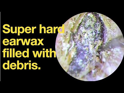 Super hard earwax filled with debris. |ear wax removal | ear cleaning | ASMR | relaxation | relax