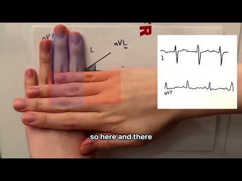 EASIEST method for cardiac axis deviation ECG