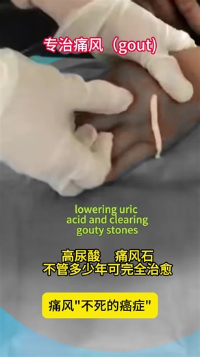 Traditional Chinese Medicine for Gout Relief