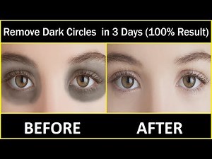 In 3 DAYS Remove Dark Circles Naturally and Permanently | (100% Results)