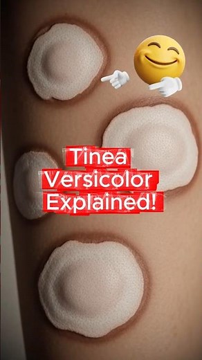 The Dermatologist's Guide to BEATING Tinea Versicolor for Good