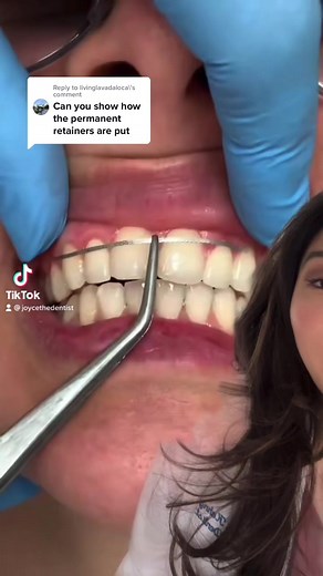 How we install the LINGUAL wire after braces! #braces #orthodontics #lingualwire #dentistryworld | JoycetheDentist