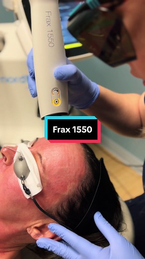Frax 1550 is a fractional laser used for deep, non-ablative skin resurfacing and skin texture improvement. It treats conditions such as wrinkles, acne scars, pore size, stretch marks, surgical scars, and more with little to no downtime. #rejuvenationcenter #medicalspa #beckleywv #skincare #nordlys #frax1550 #fraxel
