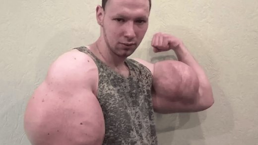 Shocking before and after photos of Russian Popeye who injected oil into biceps