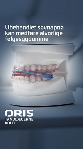 Har du søvnapnø? En CPAP-maskine hjælper med at behandle søvnapnø, men faktisk kan en tandskinne også afhjælpe, hvis du lider af let til moderat søvnapnø. Skinnen sikrer, at underkæben forbliver i en fremskudt position, så der skabes bedre passage i luftvejene. Hos ORIS Tandlægerne foregår alle søvnapnøbehandlinger i tæt samarbejde med øre-næse-halslægerne. Ubehandlet søvnapnø kan være farligt, da det dels forstyrrer nattesøvnen, men det medfører også øget risiko for at udvikle følgesygdomme som