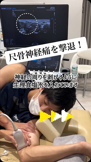 MTXスポーツ・関節クリニック on Instagram: "【肘内側の痛み・痺れ..もしかして尺骨神経障害かも⁉︎】 今回はずっと肘を曲げていると小指の方に痺れが出るケースに対して尺骨神経へのハイドロリリースを行いました！ #ハイドロリリース #整形外科 #体外衝撃波 #尺骨神経 #胸郭出口症候群 #リハビリ #理学療法士 #四ツ谷 #痺れ"