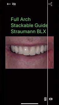 Straumann Full Arch Stackable Guide Workflow