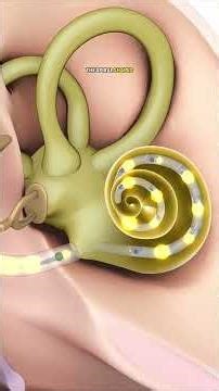 How Cochlear Implants Work 🇱🇷 Restoring the Sense of Sound